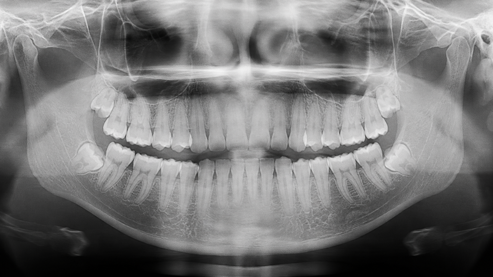 Atencion de Radiografia panoramica